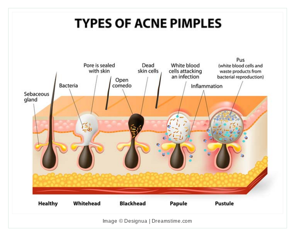 What Really Happens To Your Body When You Pop Pimples - ATTN: